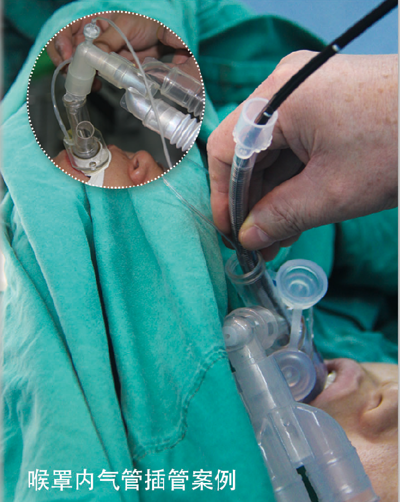 喉罩內(nèi)氣管插管使用案例